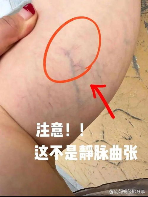我有脚气要买脚气药吗 我有脚气要买脚气药吗