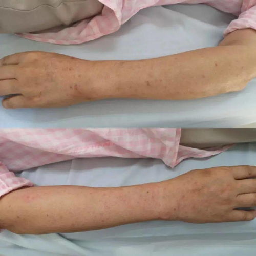 不同型灰指甲有不同症状 不同型灰指甲有不同症状