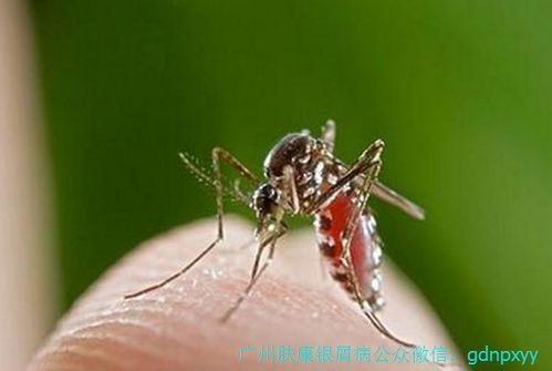 脚气溃烂感染一直流水 脚气溃烂感染一直流水