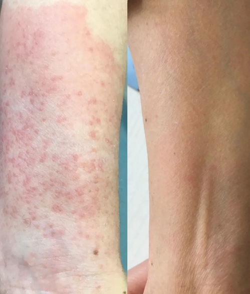 灰指甲发病早期的症状是什么样 灰指甲发病早期的症状是什么样