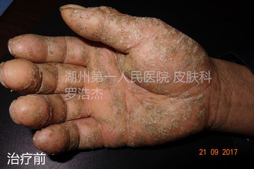 尖锐疣是艾滋病吗 尖锐疣是艾滋病吗