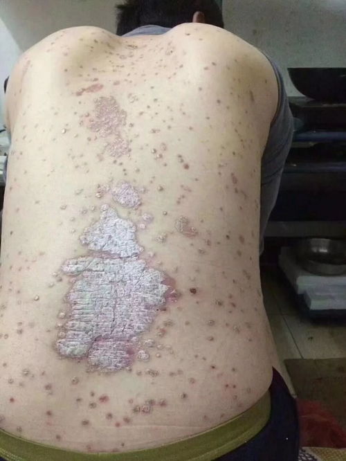 荆门哪家专治牛皮癣解密牛皮癣治疗骗局 荆门哪家专治牛皮癣解密牛皮癣治疗骗局