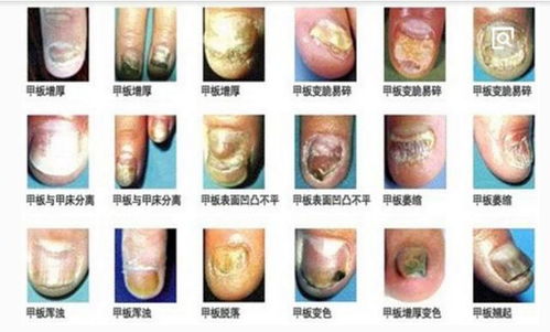 花椒与白醋治脚气的比例 花椒与白醋治脚气的比例
