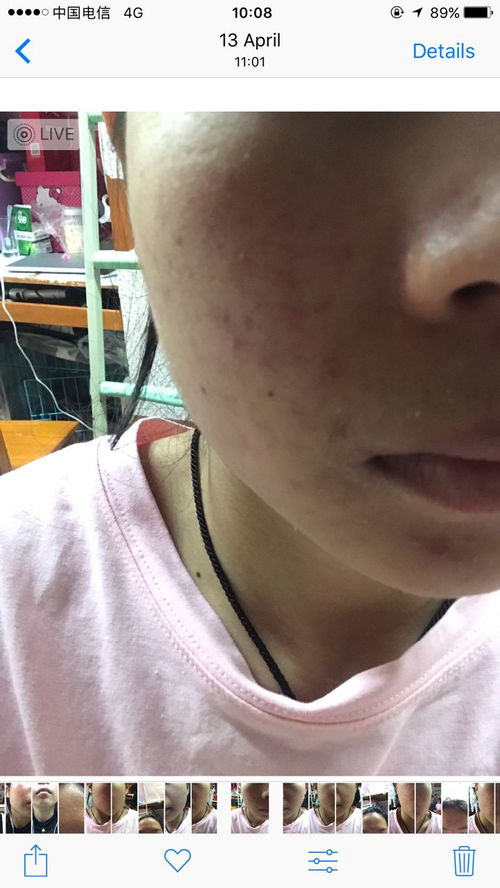 臭是脚气吗 脚只脱皮不痒不臭是脚气吗 臭是脚气吗 脚只脱皮不痒不臭是脚气吗