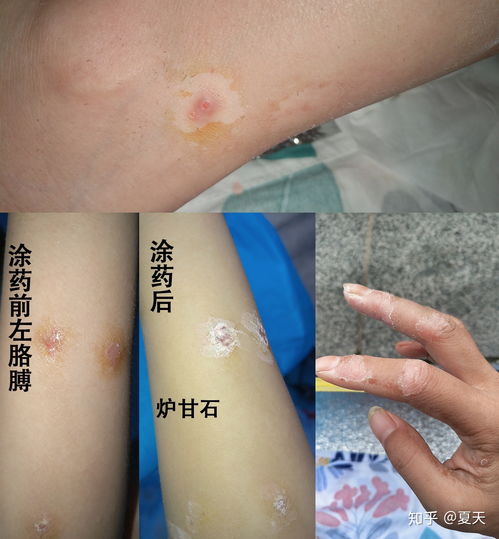 排查咽喉癌检查什么 排查咽喉癌检查什么