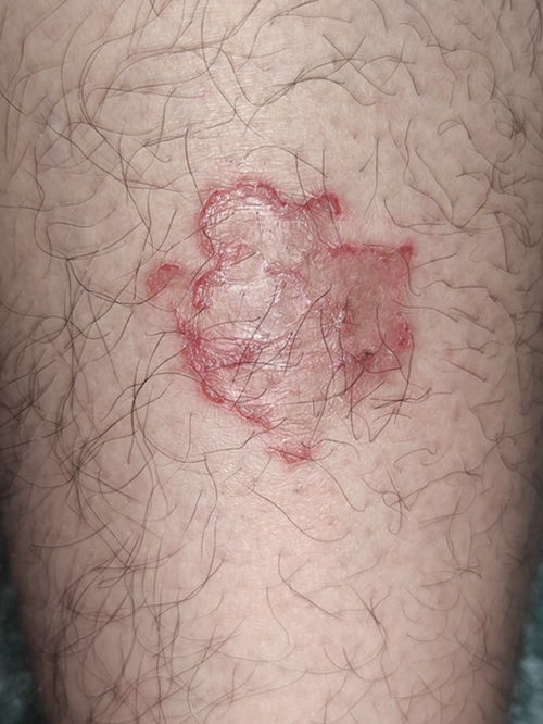 婴儿湿疹与荨麻疹有什么不同 婴儿湿疹与荨麻疹有什么不同