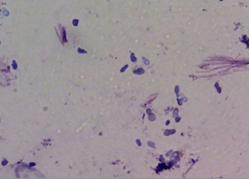 痤疮患者要怎么正确洗脸 痤疮患者要怎么正确洗脸