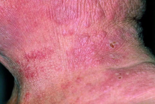 都有哪几种方法可以治疗痤疮 都有哪几种方法可以治疗痤疮