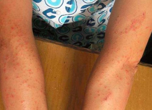 成年人得丘疹性荨麻疹多久能好 成年人得丘疹性荨麻疹多久能好