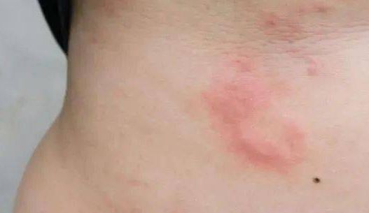 什么病引起荨麻疹表现 什么病引起荨麻疹表现