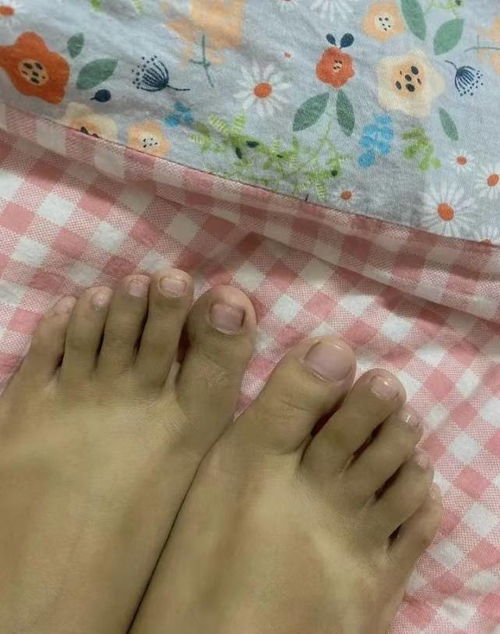 牛皮癣在治疗的时候要怎么检查 牛皮癣在治疗的时候要怎么检查