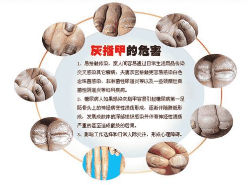 为什么会患上灰指甲 原因是什么 为什么会患上灰指甲 原因是什么