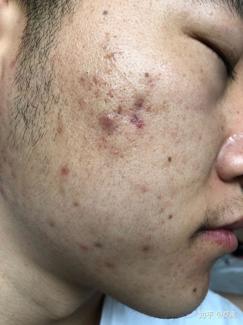 结节性红斑长什么样 结节性红斑长什么样
