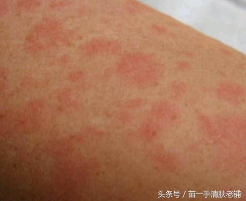 保定治牛皮癣哪家好 银屑病外显表现会有什么样的症状呢 保定治牛皮癣哪家好 银屑病外显表现会有什么样的症状呢