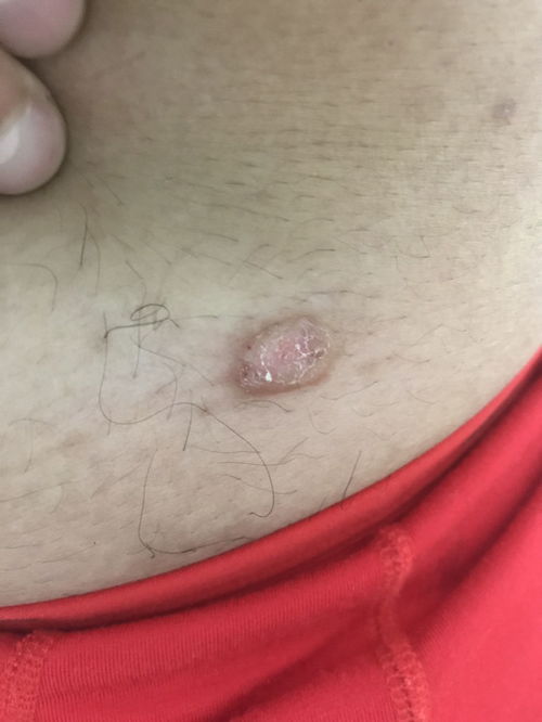 鼻子痒喉咙痒打喷嚏流鼻涕是怎么回事 鼻子痒喉咙痒打喷嚏流鼻涕是怎么回事