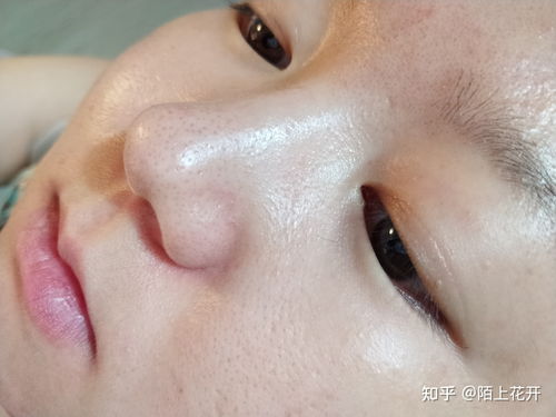 荨麻疹到底是不是风疹块 荨麻疹到底是不是风疹块