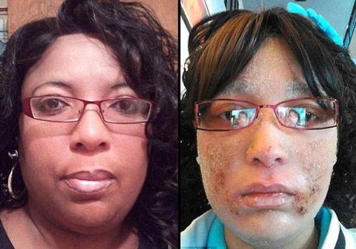 脚气的类型分为哪些 脚气的类型分为哪些