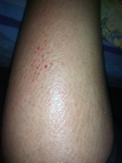 治疗灰指甲的注意事项 治疗灰指甲的注意事项