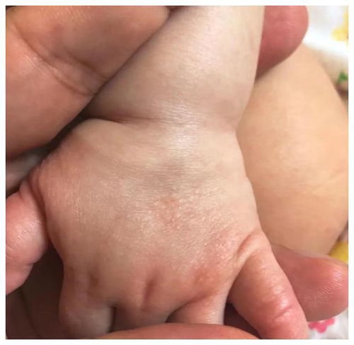 患上荨麻疹怎么办呢 患上荨麻疹怎么办呢