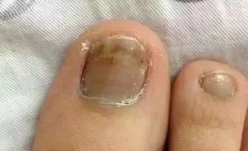 婴儿过敏性肠炎 婴儿过敏性肠炎