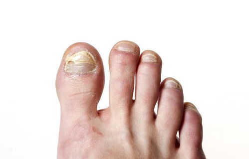 ������ĺ�ɫ̥����ôȥ��