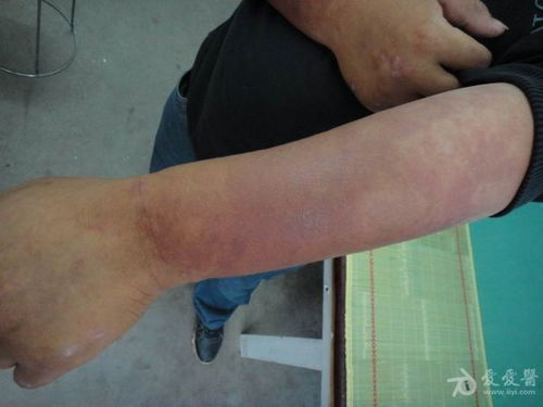 白化病产检能检查出来吗 白化病产检能检查出来吗
