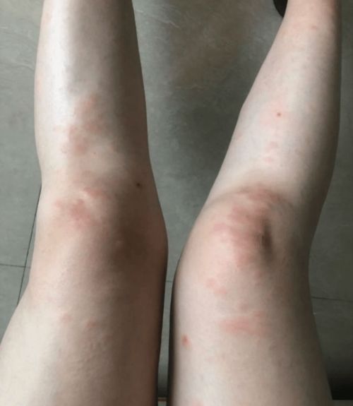 小儿荨麻疹与葡萄关联饮食指南2025新解读 小儿荨麻疹与葡萄关联饮食指南2025新解读