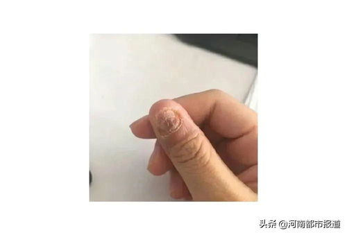出生婴儿有胎记怎么办 出生婴儿有胎记怎么办