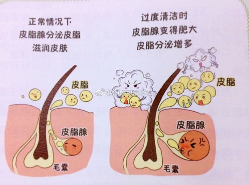 后脖子湿疹怎么办 后脖子湿疹怎么办