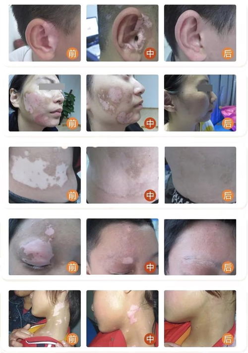 生活中如何预防小儿荨麻疹 生活中如何预防小儿荨麻疹