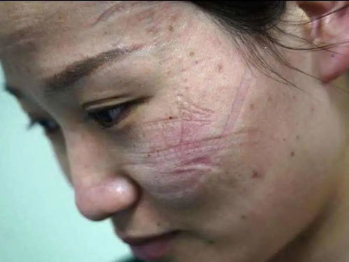男性感染梅毒什么症状 男性感染梅毒什么症状
