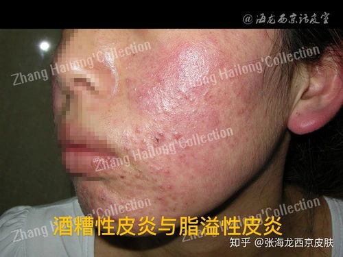 脚底起了很多小泡泡很痒是脚气吗 脚底起了很多小泡泡很痒是脚气吗