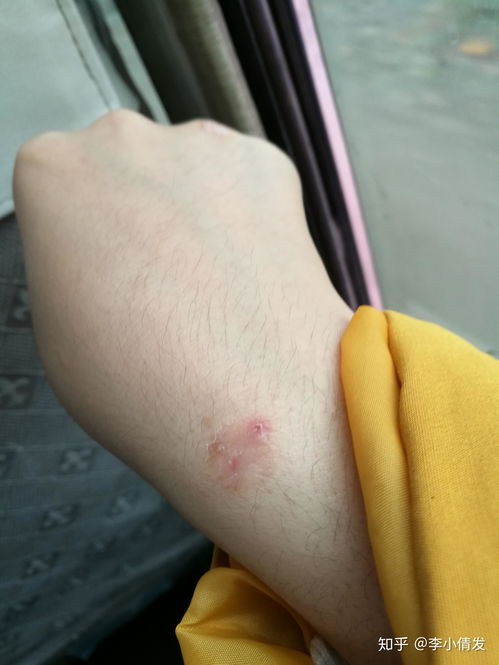 婴儿手指掉皮是什么原因 婴儿手指掉皮是什么原因