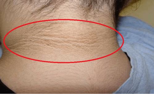 脸上痤疮容易治疗吗 脸上痤疮容易治疗吗