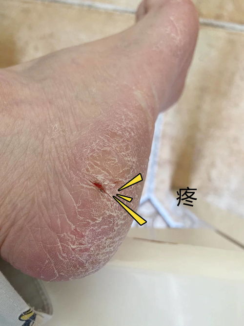 治疗脚气 治疗脚气