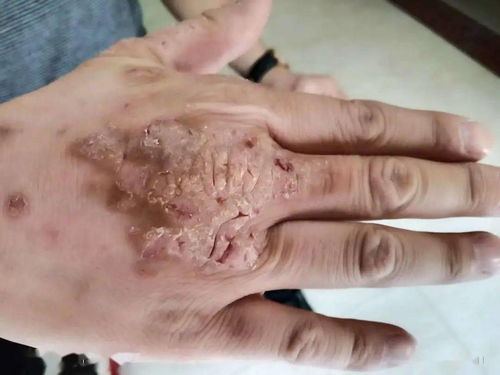 水泡破了怎么办 水泡破了怎么办