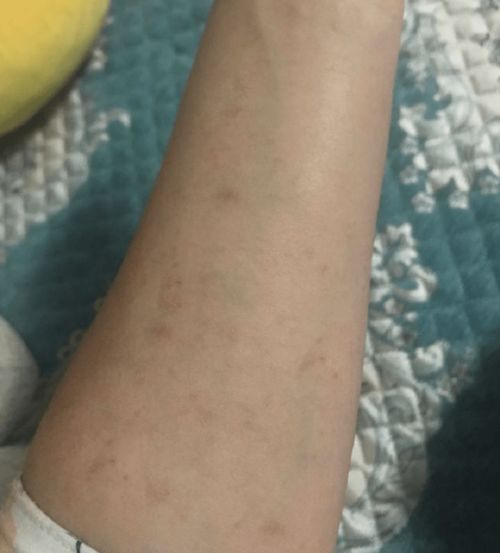手上起小水泡痒怎么治疗办 手上起小水泡痒怎么治疗办