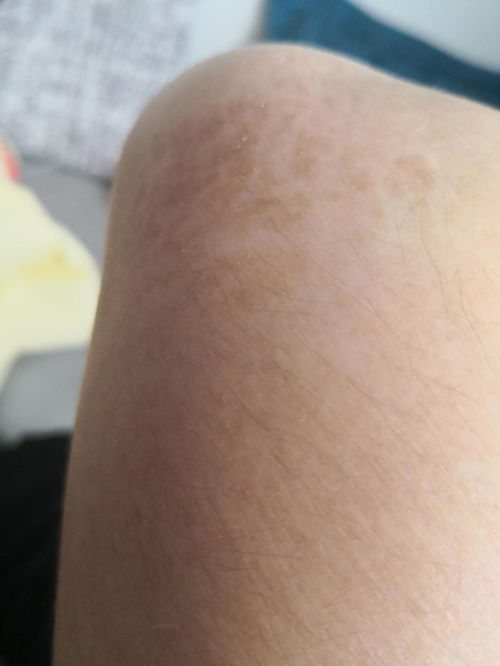 皮肤划痕症什么原因 皮肤划痕症什么原因