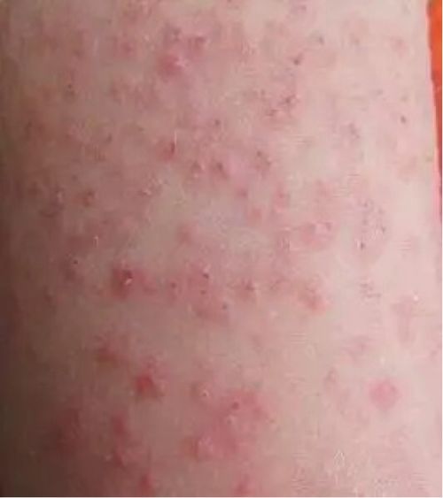 轻微灰指甲图片大全 指甲符合3个特点 你染上灰指甲了 轻微灰指甲图片大全 指甲符合3个特点 你染上灰指甲了