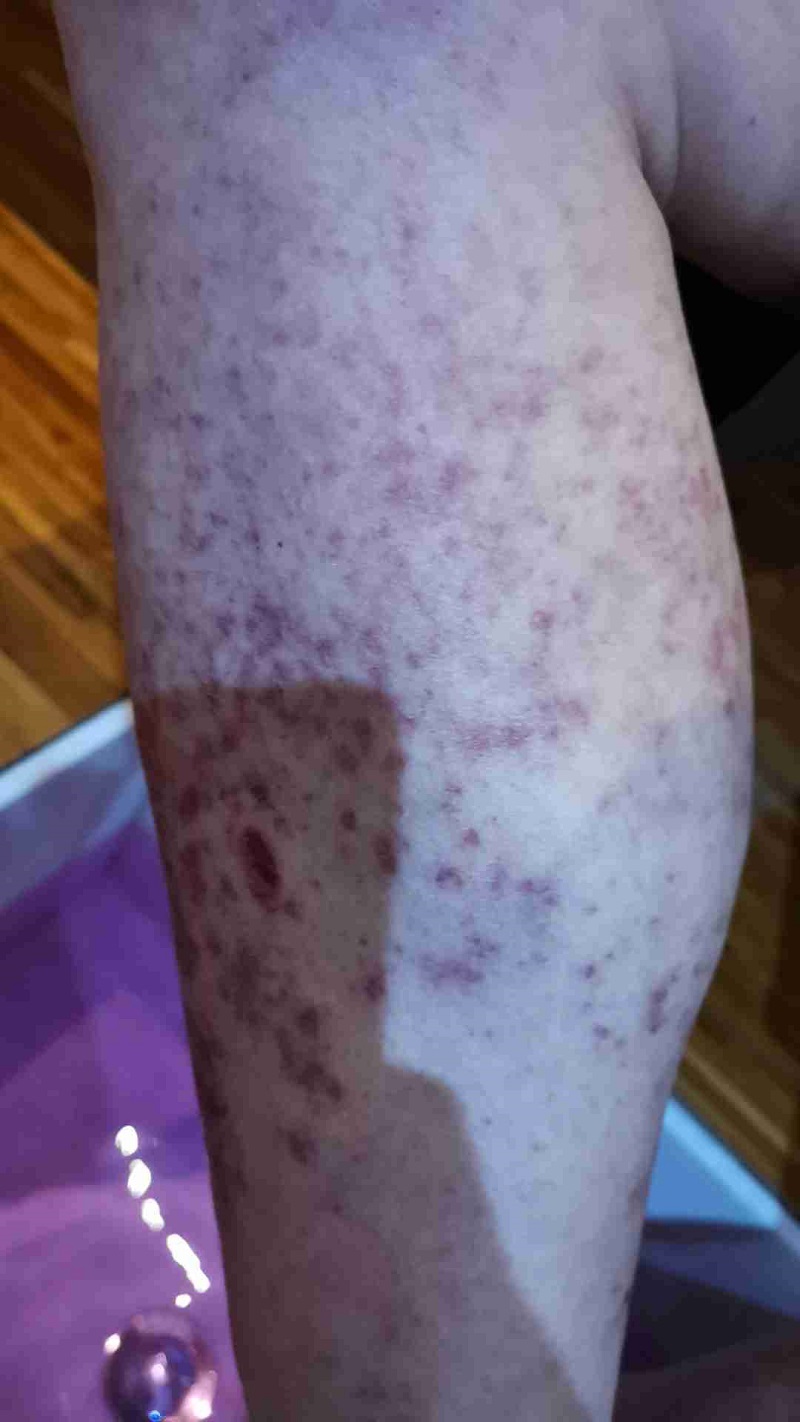 为什么糖尿病患者更易得灰指甲 为什么糖尿病患者更易得灰指甲