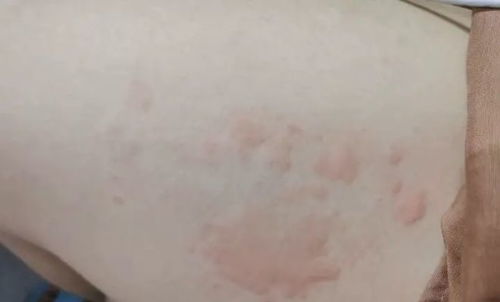 饮食不当引发荨麻疹荨麻疹患者吃什么好 饮食不当引发荨麻疹荨麻疹患者吃什么好