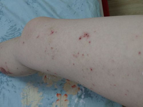 洁悠神治疗脚气很管用(洁悠神 治疗脚气高效) 洁悠神治疗脚气很管用(洁悠神 治疗脚气高效)