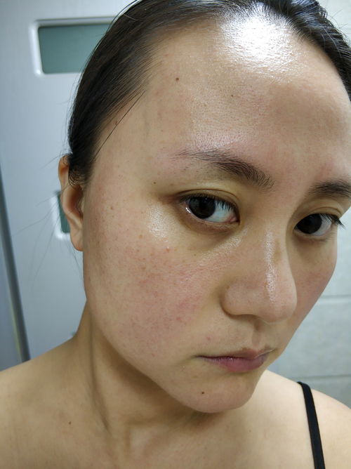 儿童疣病毒是什么引起的