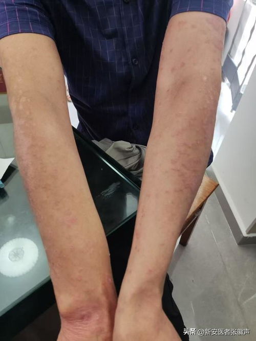 灰指甲的几种常见的疾病分类 灰指甲的几种常见的疾病分类