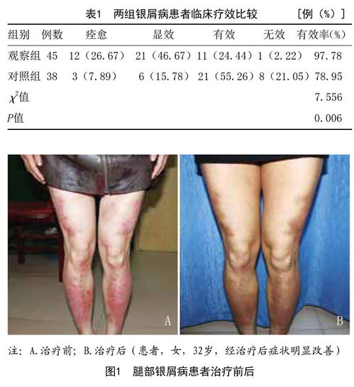 张仲景专治银屑病方子 石家庄牛皮癣 张仲景专治银屑病方子 石家庄牛皮癣