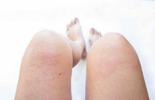 成人起痱子的原因 成人起痱子的原因
