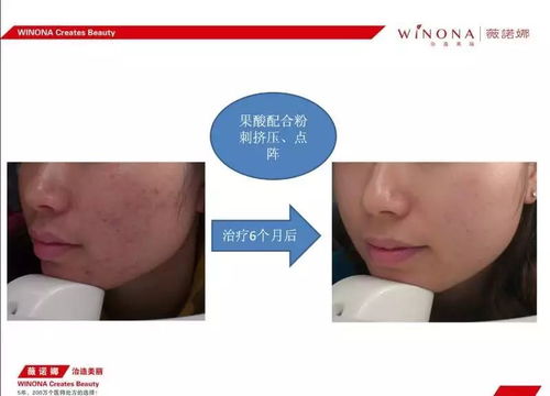 全切后还能埋线微调吗 全切后还能埋线微调吗