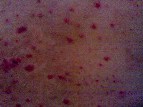 牛皮癣治疗哪家好 牛皮癣治疗哪家好