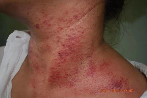 脓疱型痤疮图片 脓疱型痤疮图片