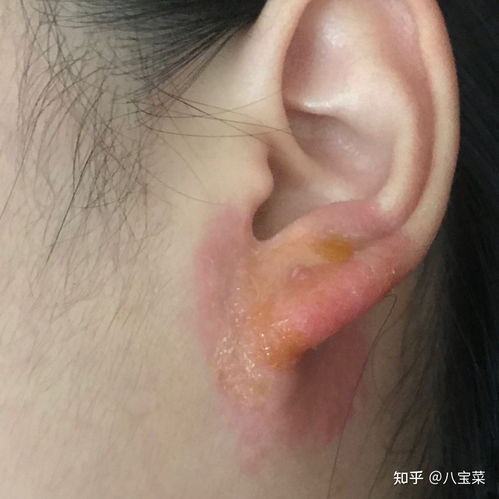 牛皮癣早期如何处理 牛皮癣早期如何处理